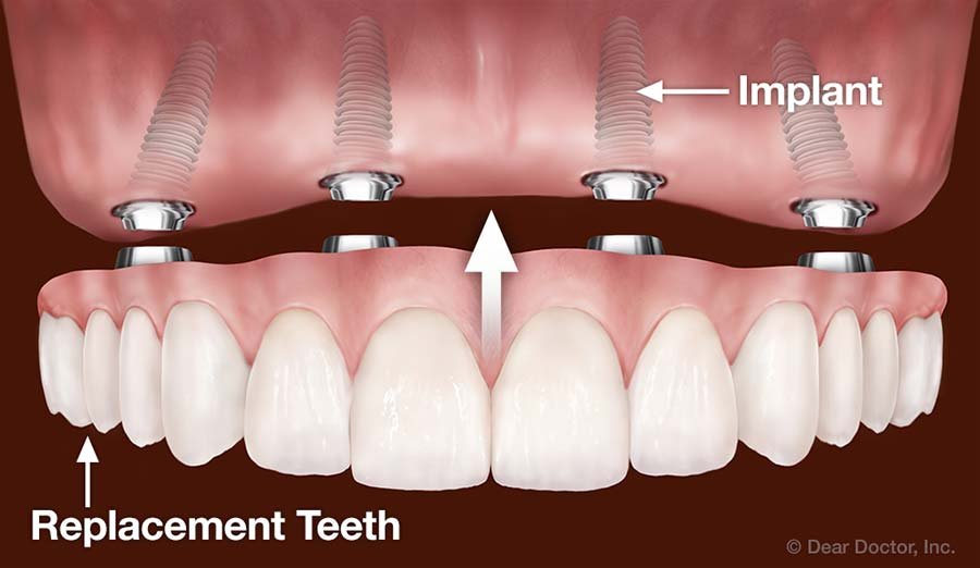 Протез на имплантах при полном отсутствии. Внутрислизистые зубные имплантаты. Имплантологическая кассета Nobel полный набор для all on 4. Несъемный протез на 4 имплантах.
