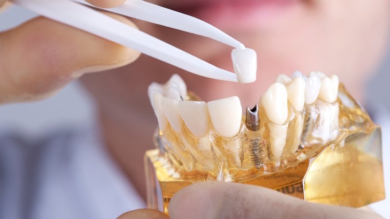 Dental Implants in Kew Gardens