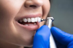 Professional Dental Cleaning