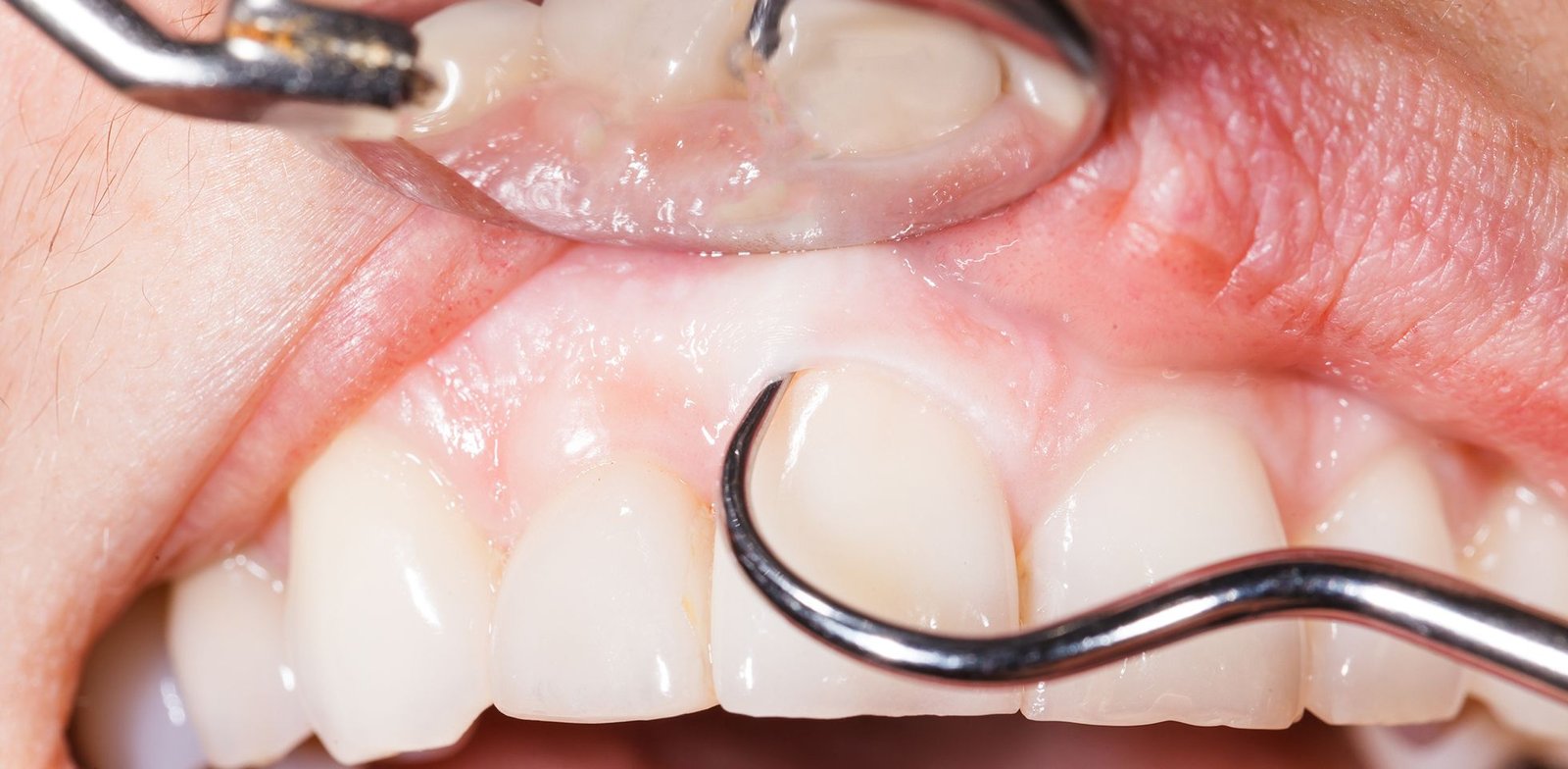 deep dental cleaning