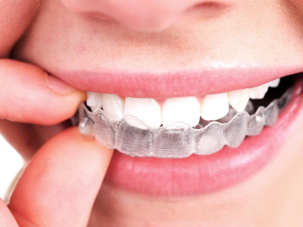 Invisalign