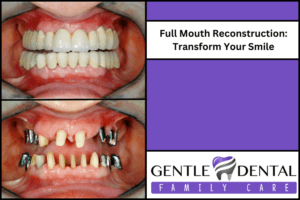 Full Mouth Reconstruction: Transform Your Smile