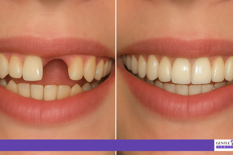 dentures and partials