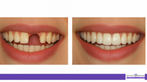 dentures and partials