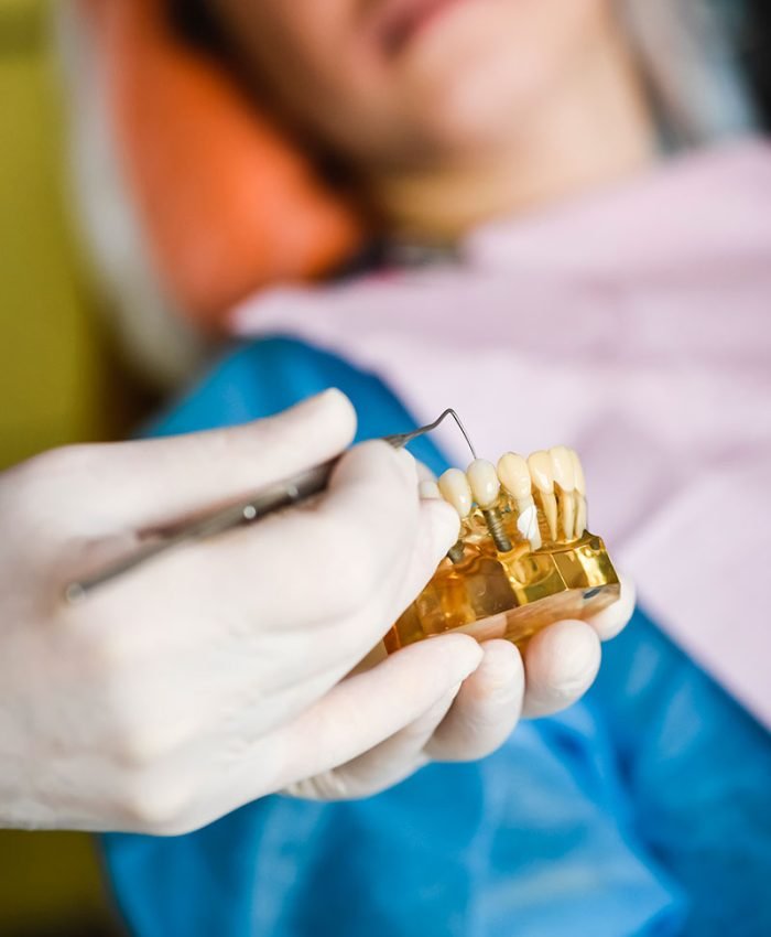Dental-Implants–1 Dental Implants in Kew Gardens | Gentle Dental Family Care