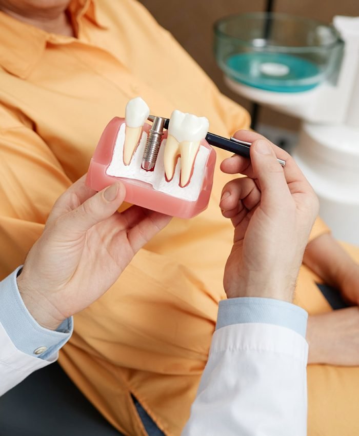 Dental-Implants–2 Dentist explaining the dental implant procedure using a model at Gentle Dental Family Care in Queens, NY.