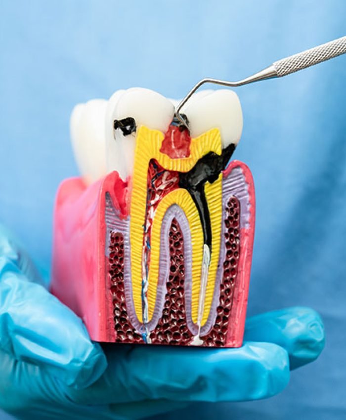 Root-Canal Root Canal Specialist | Gentle Dental Family Care in Queens, NY